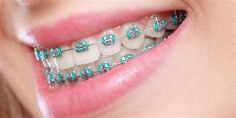 metal orthodontic brackets not corrode|orthodontic band release.